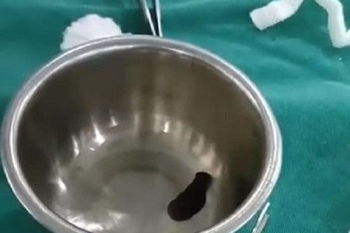 Kinh hoàng phát hiện con vắt dài 5cm sống trong hốc mũi cháu bé 7 tuổi