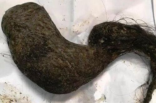 Bé gái 11 tuổi mang búi tóc gần 1kg trong dạ dày