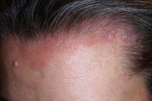 Da đầu nổi đỏ, bong tróc là bệnh gì?