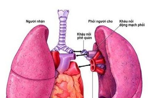 Thuốc chống đào thải dùng cho người bệnh ghép phổi