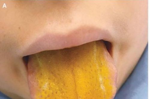 Bác sĩ cũng sốc: Bệnh nhi 12 tuổi có lưỡi vàng như nghệ