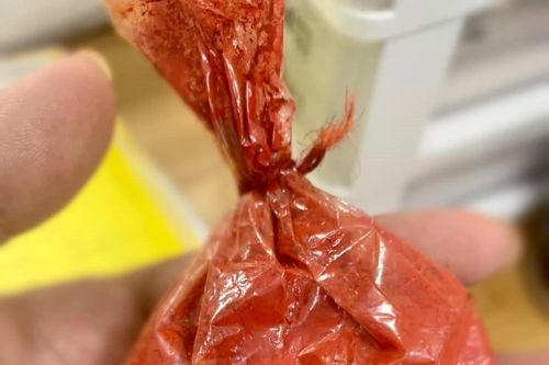 Ngộ độc sau ăn thịt bò sốt vang từ chất phụ gia lạ