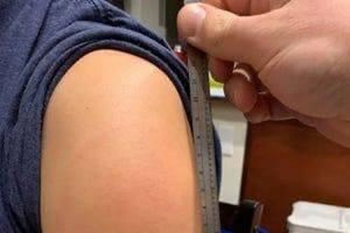 Vắc xin Moderna và phản ứng 'cánh tay COVID'