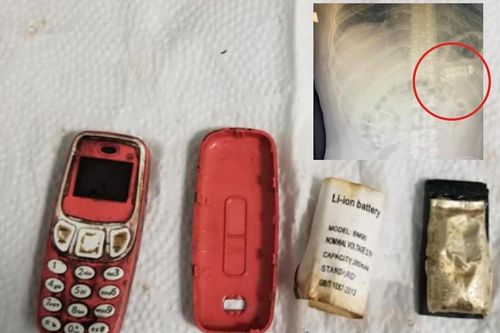Người đàn ông nuốt chửng... điện thoại di động vào bụng