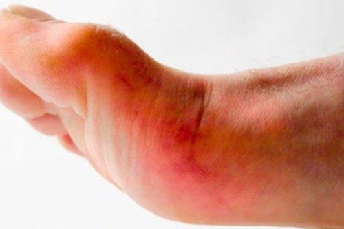 Bé gái 10 tuổi suy đa tạng sau khi bị gai nhọn đâm vào chân