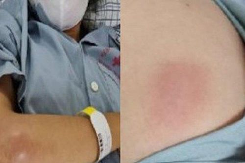 Cấp cứu kịp thời cho một phụ nữ ở Tuyên Quang mắc bệnh Whitmore