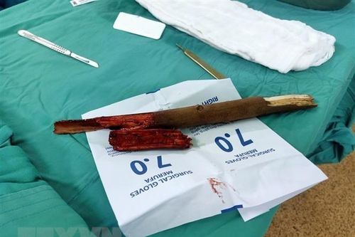Bà Rịa-Vũng Tàu: Cấp cứu thành công bệnh nhân bị cành cây đâm vào cổ