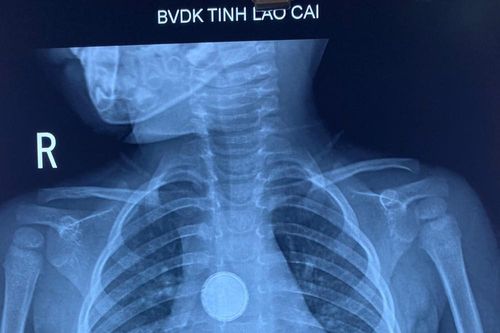 Cấp cứu thành công gắp dị vật pin cúc áo cho bệnh nhi 3 tuổi