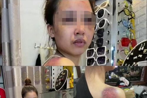 Xót xa hình ảnh cô gái nghi bị chồng bạo hành