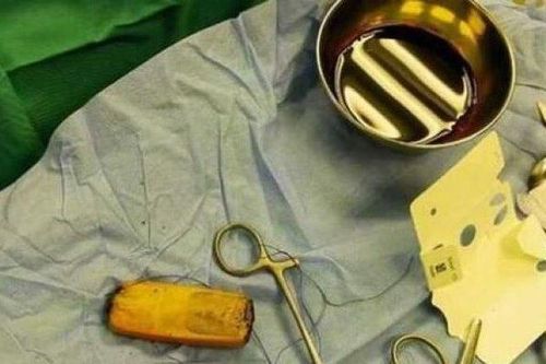 Người đàn ông sống sót kỳ diệu dù nuốt phải điện thoại 6 tháng trước