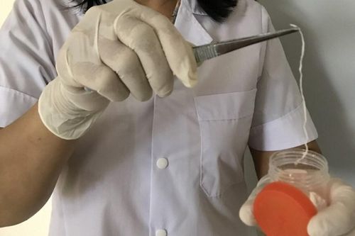 Người đàn ông bị giun rồng ký sinh trong đùi sau nhiều năm 'nghiện' tiết canh và các món tái sống