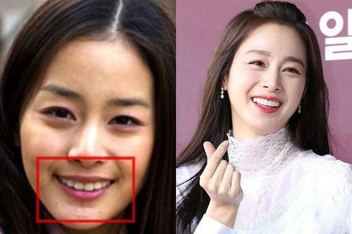 Sao Hàn lên đời nhan sắc nhờ chỉnh răng, đến Kim Tae Hee cũng không ngoại lệ
