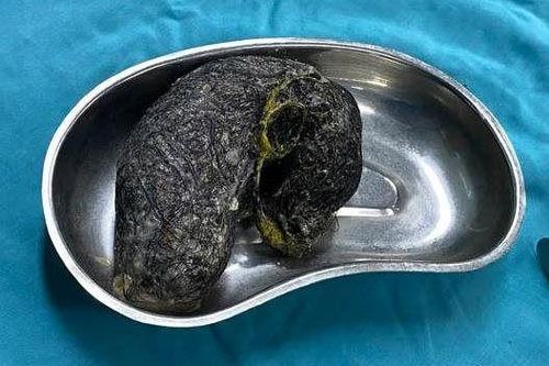 Mắc hội chứng Rapunzel, bé 7 tuổi nuốt 500gr tóc vào bụng