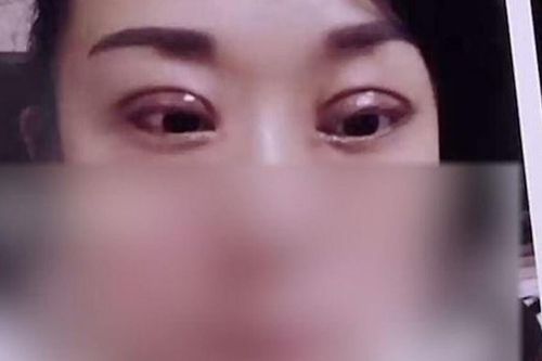 Thẩm mỹ để 'đổi phong thủy cho chồng', cô vợ 'khóc thét' với gương mặt mình sau 2 năm