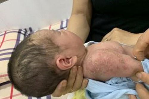 Phú Thọ: Trung tâm Y tế huyện Yên Lập điều trị khỏi bệnh viêm da mủ cho một trẻ sơ sinh