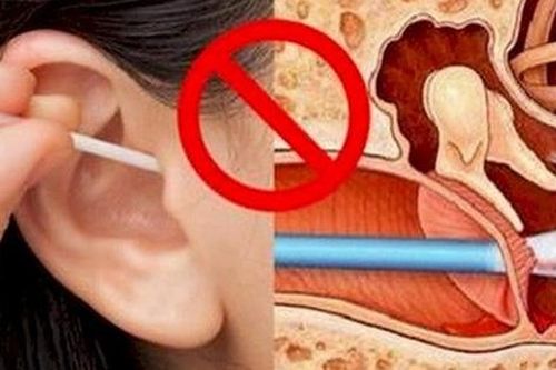 Phát hiện khối u ác tính sau nhiều năm vệ sinh tai sai cách, chuyên gia cảnh báo từ bỏ ngay sai lầm này