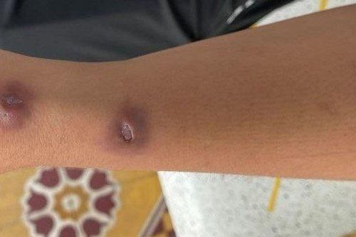 Phát hiện bệnh lao da sau khi bị gai tôm đâm