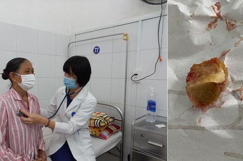 Gỡ bỏ dị vật dài 1,5cm nằm trong phế quản nữ bệnh nhân hơn 1 tháng