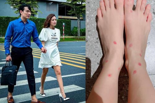 Midu lên tiếng nói rõ về bức ảnh đầy sẹo ở chân, khoe cận các vết đỏ chi chít, khiến dân tình xót thay