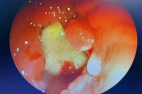 Mảnh xương lợn 1,5cm 'lưu trú' cả tháng trong phế quản người phụ nữ 67 tuổi