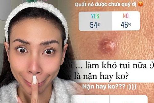Võ Hoàng Yến nặn mụn cũng hỏi ý kiến cư dân mạng