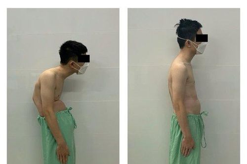Phẫu thuật thành công cho bệnh nhân gãy trật đốt sống
