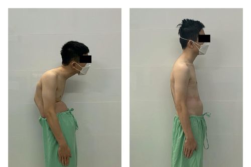 Trả lại dáng đi cho chàng trai bị còng lưng như người già