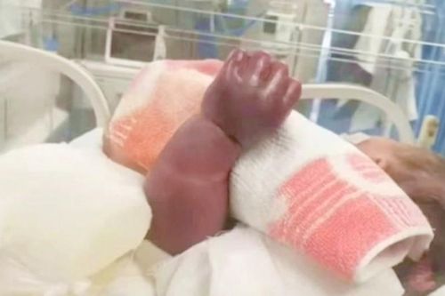 Làm điều này với con sơ sinh, mẹ suýt khiến con cụt tay