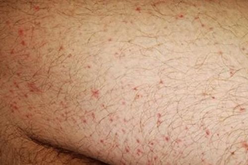 Phát ban có phải là dấu hiệu của COVID-19 không?