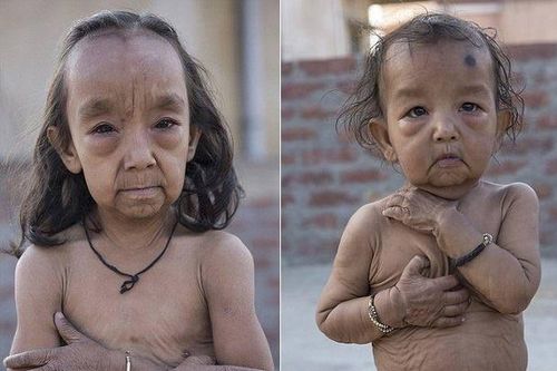 Hội chứng hiếm gặp khiến hai chị em Ấn Độ bị lão hóa, đau khớp như người già