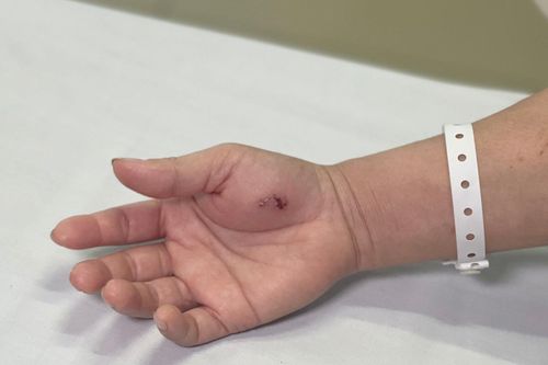 Một phụ nữ ở Hà Nội phải nhập viện do nhiễm độc sau khi bị con cu li cắn