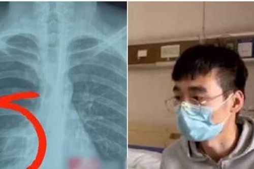 Cố hát một bài hát nhiều nốt cao, thanh niên Trung Quốc bị tổn thương phổi, suýt mất mạng