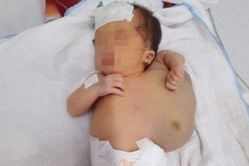 Bóc khối u bạch tuyết khổng lồ khỏi cơ thể bé 10 ngày tuổi