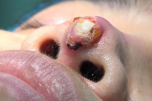 Sau phẫu thuật 4 năm, mũi người phụ nữ bị thủng, lộ cả sụn sillicon ra ngoài