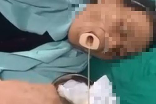 Gắp sán dây dài 6m trong dạ dày người phụ nữ hay ăn đồ tái, sống