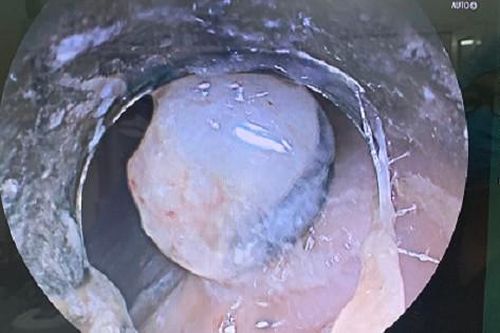 Cứu sống ngoạn mục người bệnh vỡ tĩnh mạch thực quản