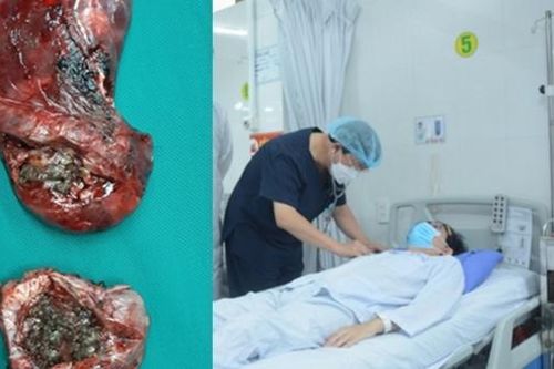 Bóc 2 khối u nấm khủng 'mọc ổ' trong phổi nam thanh niên