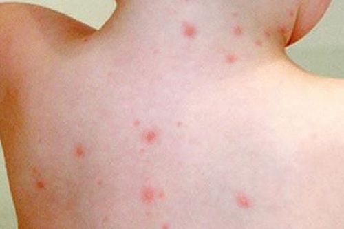 Trên người con gái nhỏ liên tục có chấm đỏ kỳ lạ, bố mẹ đưa đi khám mới ngớ người khóc ròng, tự trách mình vì cách giáo dục con sai lầm