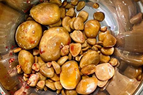 Bác sĩ lấy cả rổ sỏi ra khỏi bàng quang bệnh nhân