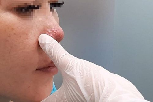 Cô gái 'tá hỏa' khi vùng mũi miệng tím bầm, biến dạng sau 3 ngày tiêm filler ở spa