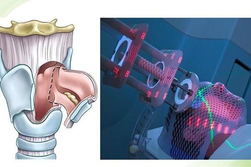 Ứng dụng phẫu thuật laser vi phẫu qua đường miệng trong điều trị ung thư thanh quản