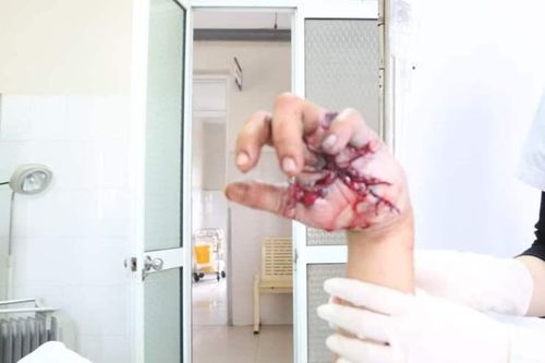 Phú Thọ: Pháo tự chế phát nổ, bàn tay của nam sinh bị xẻ làm đôi