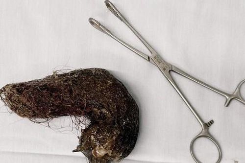 Búi tóc khoảng 1kg căng phồng chiếm trọn lòng dạ dày bé gái 5 tuổi