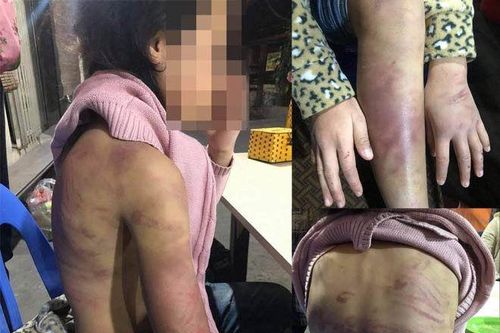 Bạo hành trẻ em: Vết thương tinh thần khó lành