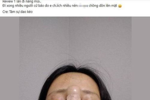 Cô gái gây hãi hùng khi nhìn thành quả của màn nâng mũi