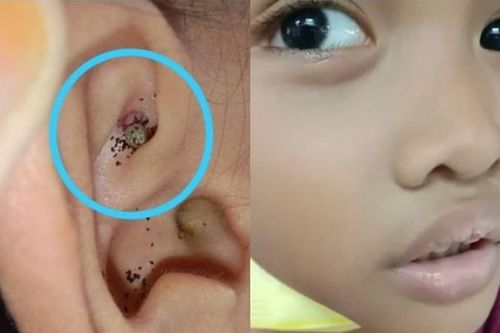 Bé trai đau tai, kiểm tra phát hiện 'quái vật' ghê rợn ký sinh