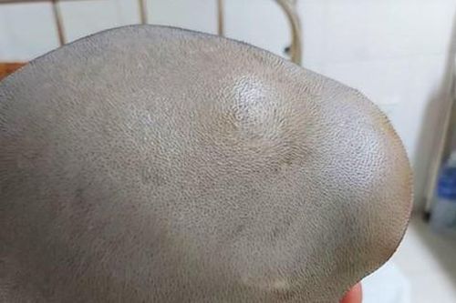 Bé 12 tuổi thường xuyên đau đầu, thời gian ngắn sau u não 'đội lên' to bằng quả trứng