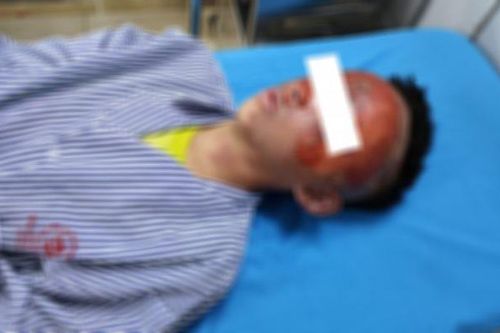 Tự chế pháo nổ, thiếu niên 14 tuổi bỏng mặt
