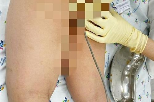 Ca cấp cứu 'có một không hai': Trẻ nhét cây thông cống dài nửa mét vào hậu môn