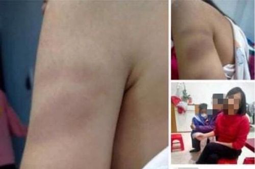 Hải Phòng: Xử lý nghiêm cô giáo dùng thước đánh tím tay học sinh lớp 1